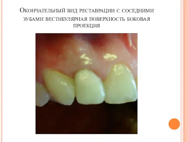 Окончательный вид реставрации с соседними зубами вестибулярная поверхность боковая проекция