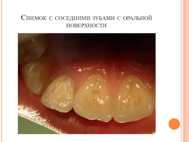 Снимок с соседними зубами с оральной поверхности