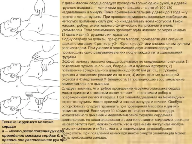 Техника наружного массажа сердца: а — место расположения рук при проведении массажа