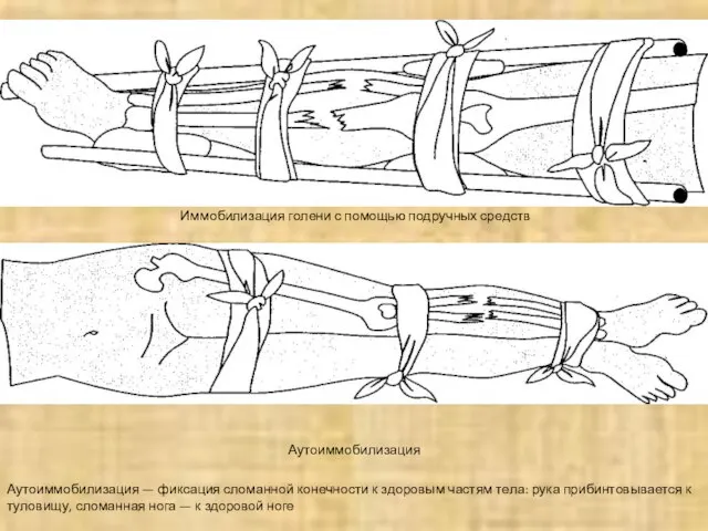 Иммобилизация голени с помощью подручных средств Аутоиммобилизация Аутоиммобилизация — фиксация сломанной конечности