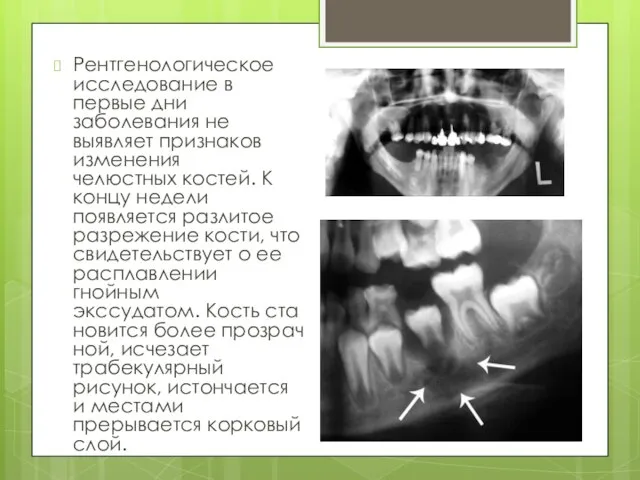 Рентгенологическое исследование в первые дни заболевания не выявляет признаков изменения челюстных костей.