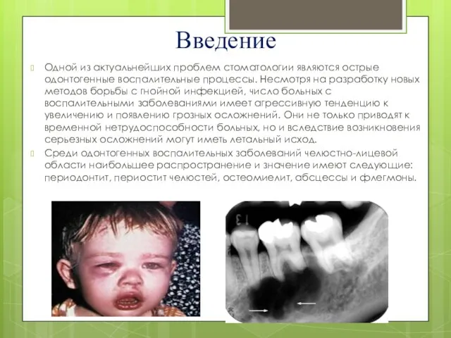Введение Одной из актуальнейших проблем стоматологии являются острые одонтогенные воспалительные процессы. Несмотря