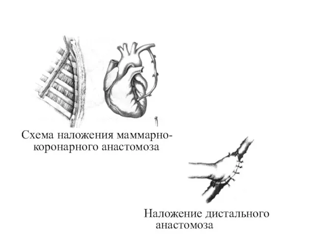 Схема наложения маммарно-коронарного анастомоза Наложение дистального анастомоза