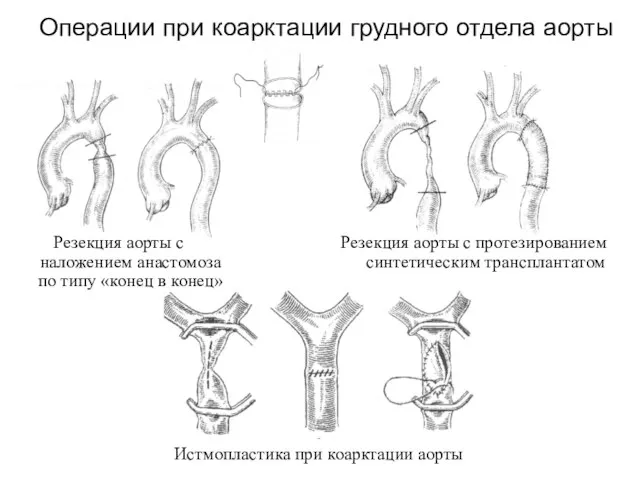 Операции при коарктации грудного отдела аорты Резекция аорты с наложением анастомоза по