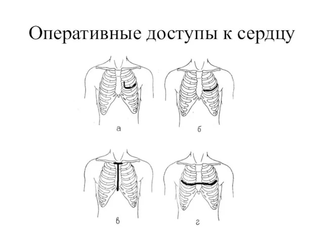 Оперативные доступы к сердцу