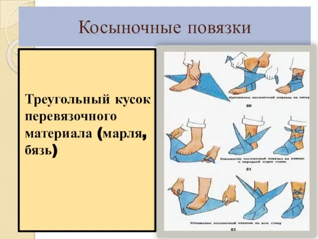 Косыночные повязки Треугольный кусок перевязочного материала (марля, бязь)