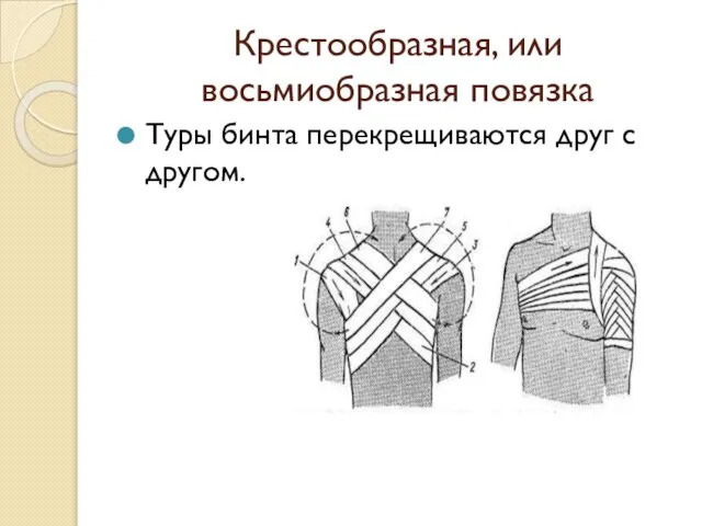 Крестообразная, или восьмиобразная повязка Туры бинта перекрещиваются друг с другом.