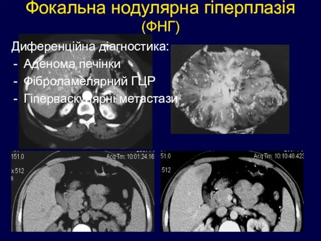 Фокальна нодулярна гіперплазія (ФНГ) Диференційна діагностика: Аденома печінки Фіброламелярний ГЦР Гіперваскулярні метастази