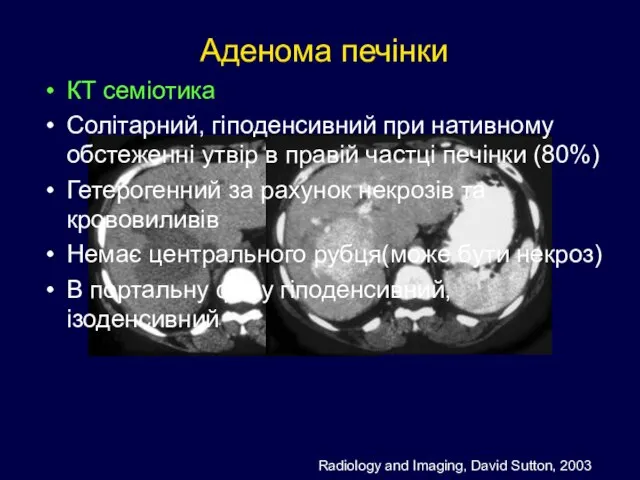 Аденома печінки КТ семіотика Солітарний, гіподенсивний при нативному обстеженні утвір в правій