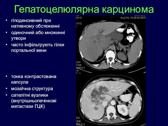 гіподенсивний при нативному обстеженні одиночний або множинні утвори часто інфільтрують гілки портальної