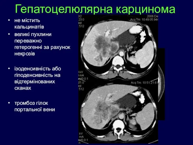 не містить кальцинатів великі пухлини переважно гетерогенні за рахунок некрозів ізоденсивність або