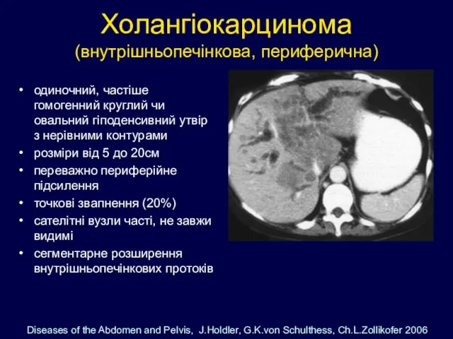 Холангіокарцинома (внутрішньопечінкова, периферична) одиночний, частіше гомогенний круглий чи овальний гіподенсивний утвір з