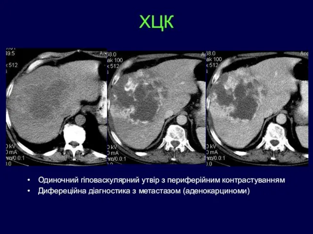 ХЦК Одиночний гіповаскулярний утвір з периферійним контрастуванням Дифереційна діагностика з метастазом (аденокарциноми)