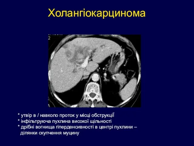 Холангіокарцинома * утвір в / навколо проток у місці обструкціЇ * інфільтруюча