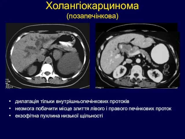 Холангіокарцинома (позапечінкова) дилатація тільки внутрішньопечінкових протоків незмога побачити місце злиття лівого і