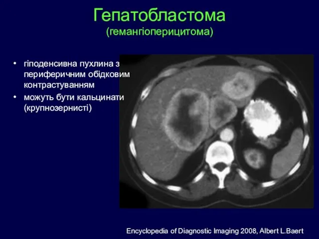 Гепатобластома (гемангіоперицитома) гіподенсивна пухлина з периферичним обідковим контрастуванням можуть бути кальцинати (крупнозернисті)