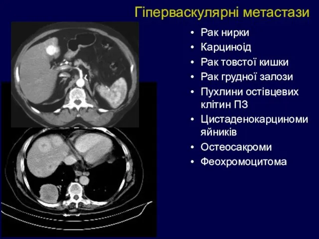 Рак нирки Карциноід Рак товстої кишки Рак грудної залози Пухлини остівцевих клітин