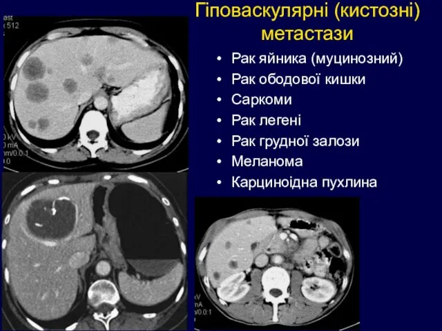 Гіповаскулярні (кистозні) метастази Рак яйника (муцинозний) Рак ободової кишки Саркоми Рак легені