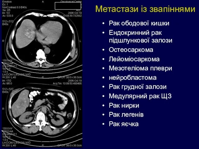 Метастази із звапіннями Рак ободової кишки Ендокринний рак підшлункової залози Остеосаркома Лейоміосаркома