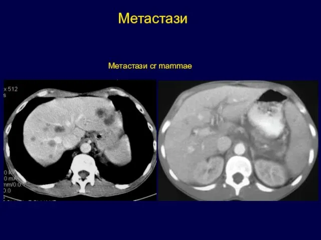 Метастази Метастази cr mammae