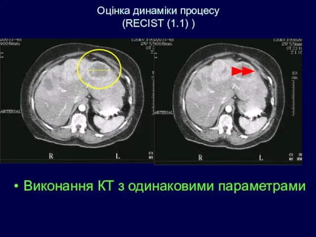 Оцінка динаміки процесу (RECIST (1.1) ) Виконання КТ з одинаковими параметрами