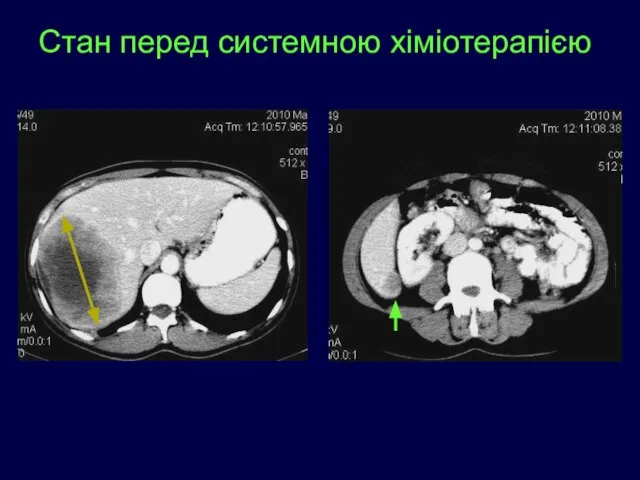 Стан перед системною хіміотерапією