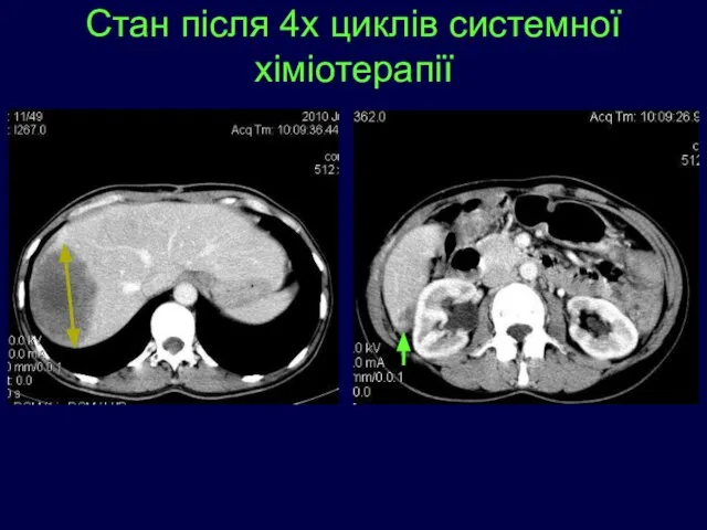 Стан після 4х циклів системної хіміотерапії