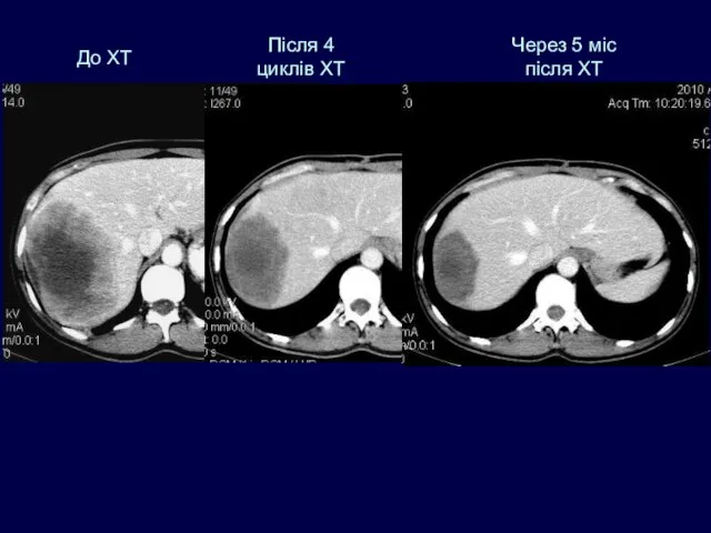 До ХТ Після 4 циклів ХТ Через 5 міс після ХТ