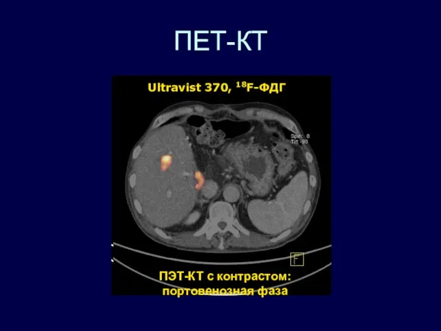 ПЕТ-КТ Ultravist 370, 18F-ФДГ ПЭТ-КТ с контрастом: портовенозная фаза