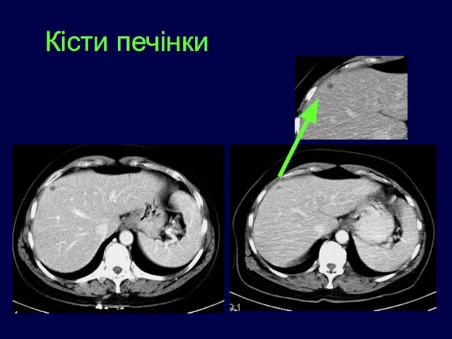 Кісти печінки