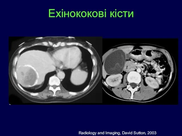 Ехінококові кісти Radiology and Imaging, David Sutton, 2003