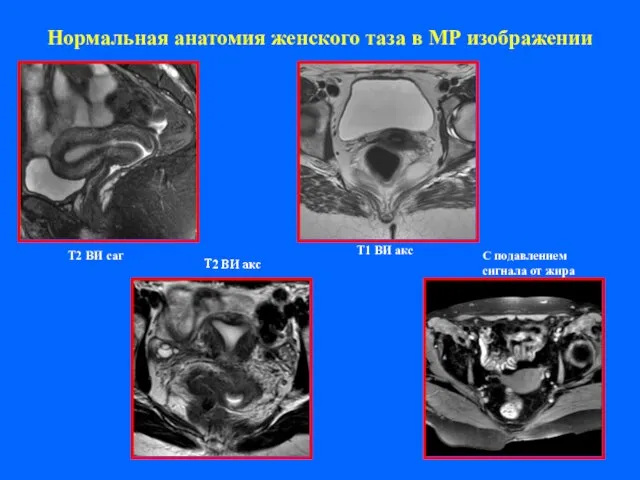 Нормальная анатомия женского таза в МР изображении Т2 ВИ саг Т2 ВИ