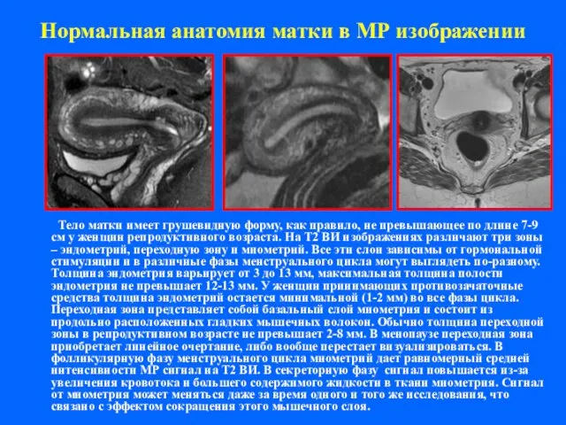 Нормальная анатомия матки в МР изображении Тело матки имеет грушевидную форму, как