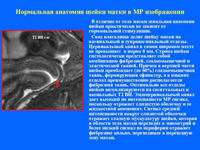 Нормальная анатомия шейки матки в МР изображении В отличие от тела матки