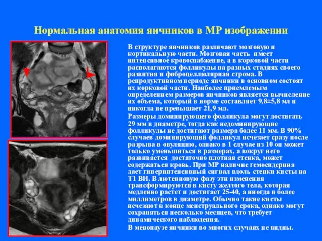 Нормальная анатомия яичников в МР изображении В структуре яичников различают мозговую и