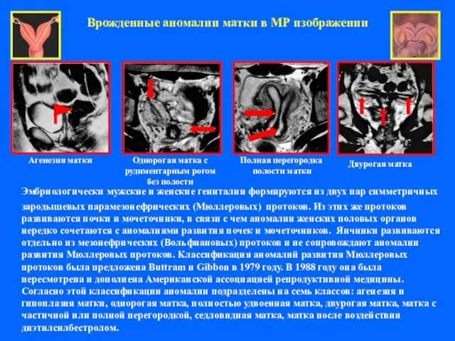 Врожденные аномалии матки в МР изображении Эмбриологически мужские и женские гениталии формируются