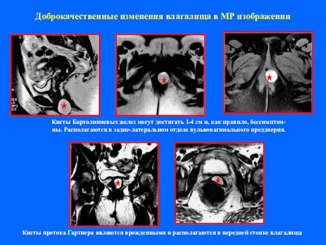 Доброкачественные изменения влагалища в МР изображении Кисты Бартолиниевых желез могут достигать 1-4