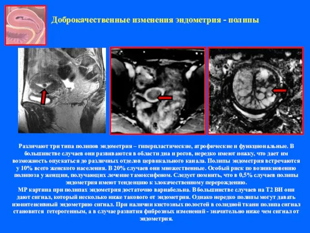 Доброкачественные изменения эндометрия - полипы Различают три типа полипов эндометрия – гиперпластические,