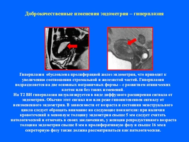 Доброкачественные изменения эндометрия – гиперплазия Гиперплазия обусловлена пролиферацией желез эндометрия, что приводит