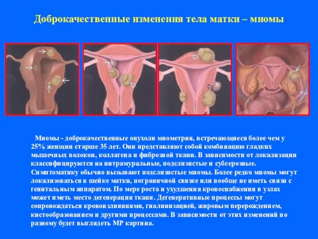 Доброкачественные изменения тела матки – миомы Миомы - доброкачественные опухоли миометрия, встречающиеся