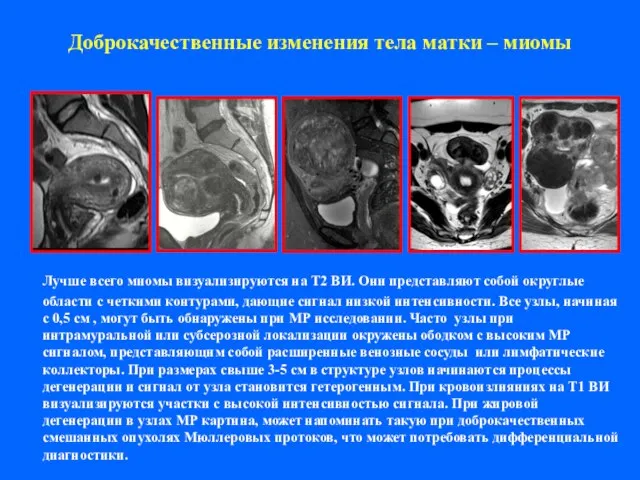 Доброкачественные изменения тела матки – миомы Лучше всего миомы визуализируются на Т2