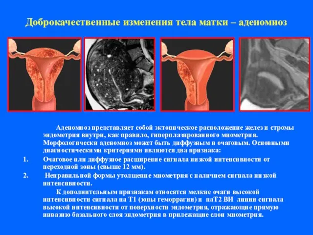 Доброкачественные изменения тела матки – аденомиоз Аденомиоз представляет собой эктопическое расположение желез