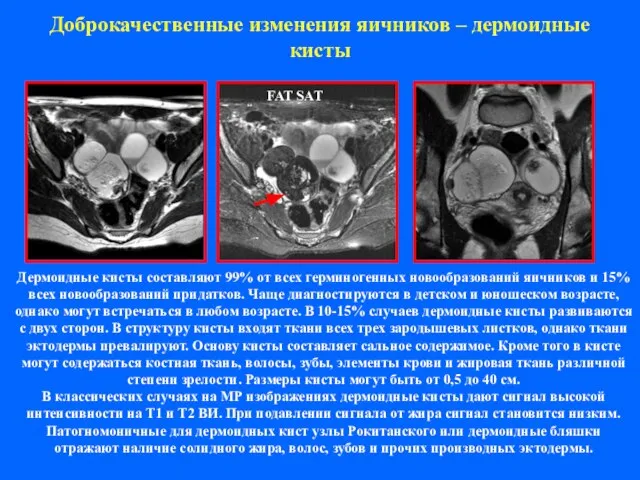 Доброкачественные изменения яичников – дермоидные кисты Дермоидные кисты составляют 99% от всех