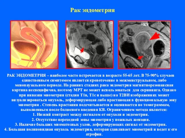 Рак эндометрия РАК ЭНДОМЕТРИЯ – наиболее часто встречается в возрасте 55-65 лет.