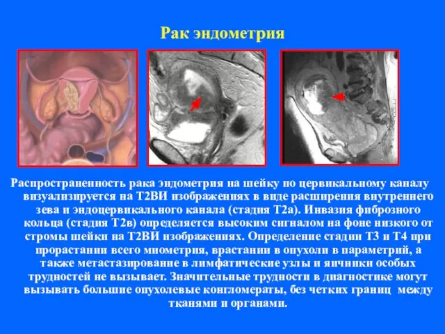 Рак эндометрия Распространенность рака эндометрия на шейку по цервикальному каналу визуализируется на