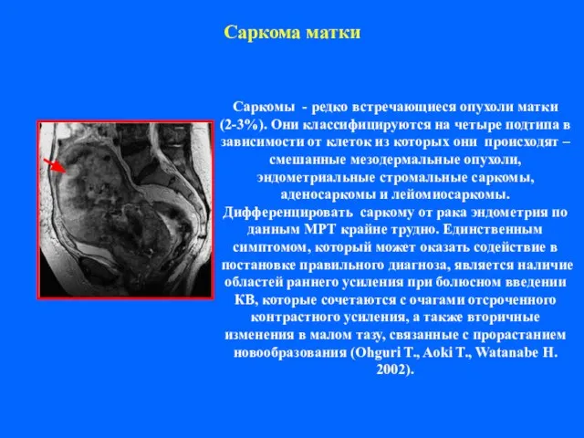 Саркома матки Саркомы - редко встречающиеся опухоли матки (2-3%). Они классифицируются на