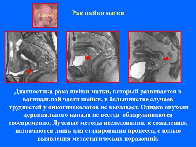 Рак шейки матки Диагностика рака шейки матки, который развивается в вагинальной части