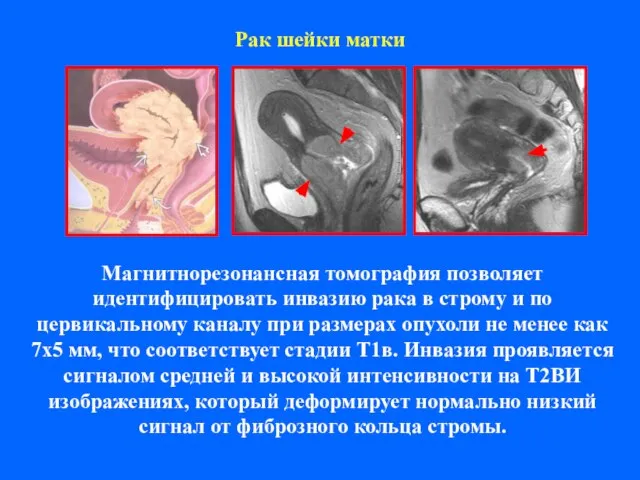 Рак шейки матки Магнитнорезонансная томография позволяет идентифицировать инвазию рака в строму и