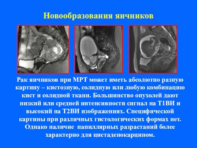 Новообразования яичников Рак яичников при МРТ может иметь абсолютно разную картину –