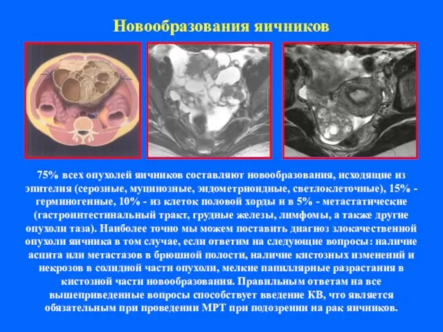 Новообразования яичников 75% всех опухолей яичников составляют новообразования, исходящие из эпителия (серозные,